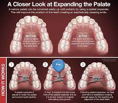 Pin On Orthodontic Topics