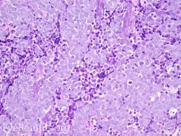 Clinical differential diagnoses include basal cell carcinoma, cyst, amelanotic melanoma, lymphoma and atypical fibroxanthoma. Malignant Lesions Of The External Periocular Tissues Tutorial