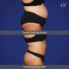 Dr Z At Hz Plastic Surgery In Orlando Performed A Tummy Tuck And Liposuction Our Patient Is 3 Months Post Tummy Tucks Tummy Tuck Before After Plastic Surgery