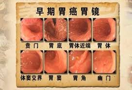 胃癌（いがん、英：stomach cancer または gastric cancer）は、胃に生じる上皮性悪性腫瘍・癌の総称。初期の症状には、胸やけ、上腹部の痛み、吐き気、食欲不振などがある。進行すると、体重減少、嘔吐、嚥下困難、下血などの症状が出現する。 èƒƒç™Œæ™šæœŸèƒ½æ´»å¤šä¹… èƒƒç™Œæ™šæœŸæœ‰ä»€ä¹ˆç—‡çŠ¶ å¦‚ä½•æ²»ç–—èƒƒç™Œ æ¯æ—¥å¤´æ¡