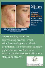 Microneedling Is A Skin Rejuvenating Process Which Stimulates Production Of Collagen And Elastin Which P Microneedling Best Face Products Stimulation