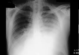 Notice that even within each lobe pleural effusion is not always visible as a meniscus in the costophrenic angle. Nausea Vomiting And Abdominal Pain With Pleural Effusion