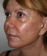 Facial Plastic Surgery in Brookline, MA