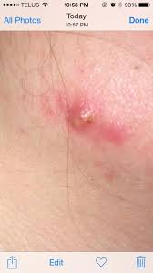 It can be hard to resist the urge to pop a pimple, but dr. What Is This Hard Pimple Bump On My Jawline Hormonal Acne Acne Org