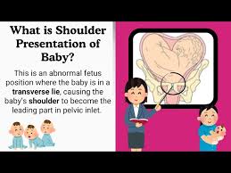 Image result for Shoulder Presentation