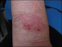 Image result for Hypertrichosis