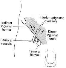 How To Check Your Inguinal Lymph Nodes Lymph Nodes Lymphatic System Lymphedema