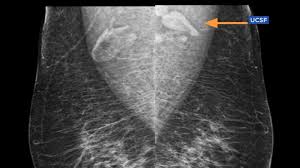 Head and neck cancer can cause pain or a burning sensation when chewing and swallowing food. Swollen Lymph Nodes Doctors Explain The Covid Vaccine Side Effect That S Being Mistaken For Breast Cancer Abc7 San Francisco