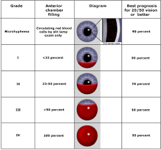 Image result for Hyphema