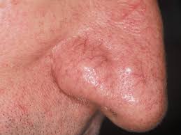 Mais s'il était vraiment possible d'envoyer des robots dans nos vaisseaux sanguins ? Laser Couperose Rosacee Dermatologie Face Au Temps