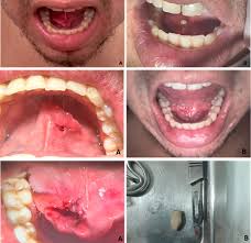 Image result for Sialolithiasis