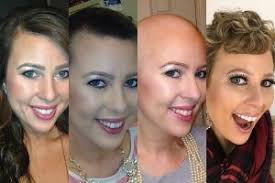 Hair loss may happen a little at a time or in clumps. Reducing Hair Loss From Chemotherapy