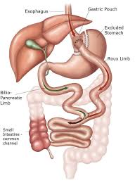 gastric byp surgery houston weight