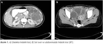 nadir bir olgu tuboovaryan apseye neden olan hidatik kist