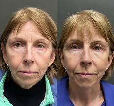 We are doing a happy dance going into the weekend with these beautiful  Mini-Facelift results!! This patient was pleased to easily replace her  tired look for a refreshed appearance. 🌟Here are some