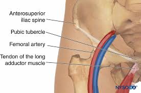 Image result for Obturator Nerve Compression