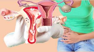 Pin Di Obat Kista