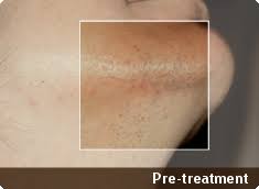 Discover laser hair removal deals in and near windsor, on and save up to 70% off. Laser Hair Removal Laser It Salon Medical Spa Windsor Waxing Manicure Massage