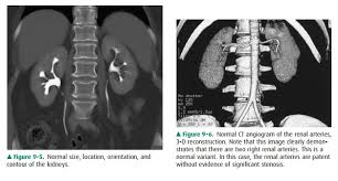 Image result for Helical CT Urogram