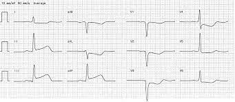 Der herzinfarkt ist eine der häufigsten todesursachen in den westlichen industrieländern. Myokardinfarkt Fokus Ekg