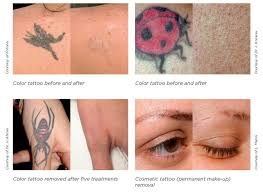Our doctors deliver breakthrough results in the removal of unwanted tattoos. Laser Tattoo Removal Neutral Bay Sydney Tattoo Removal Specialists