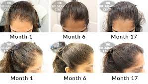 Belgravia hairloss clinic are a joke charging yearly programmes for topicals with little or no clinical studies between them. Hair Growth Success Very Happy With The Results