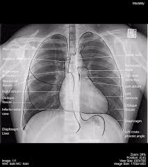 Conclusion of living anatomy of the chest congratulations! Chest Undergraduate Diagnostic Imaging Fundamentals