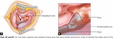 Endolymphatic Sac Surgery For Meniere S Disease Semantic Scholar