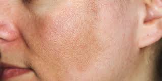 Why do i have dark patches on my face? White Spots On Face Possible Causes And Medical Treatments