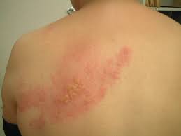 Image result for herpes zoster