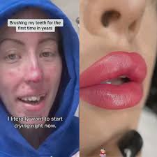 It’s been years 😥 abi.burleigh #dentalhygiene #dentalhygienist  #periodontaldisease #mouthdisease brushing my teeth for the first time in  years #tiktokuni #fypシ゚viral #pov #foryoupage #fypツ 😉