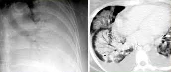 Image result for Air Bronchogram