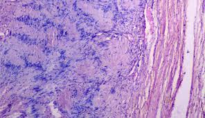 The nuclei palisade to form verocay bodies. Histopathology Of Vagal Nerve Schwannoma Download Scientific Diagram