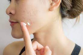 Acne Banco De Imagens E Fotos De Stock Istock