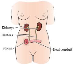 About Your Urostomy Memorial Sloan Kettering Cancer Center