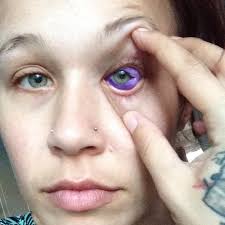 It has a huge number of varieties and incredibly deep ancient sense. Sclera Tattoo Causes Model S Severe Eye Infection Possible Blindness Teen Vogue