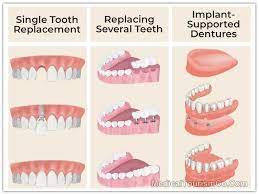 Since 1868 atlanta dental has focused exclusively on serving our customers with quality products, services, and technology. Dental Implants In Mexico Low Cost Full Mouth Implants