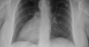 Douleur à la poitrine : Ken Le Survivant Mgs2 Et Grey S Anatomy Ont Un Point Commun