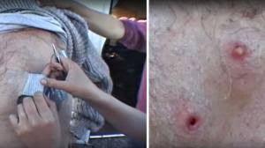 Elle Se Debarrasse D Un Bouton Qui Lui Bouche Les Pores De La Peau Depuis 20