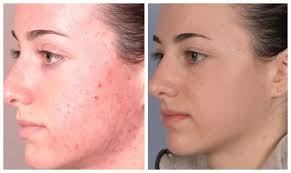 What is Permanent Makeup?