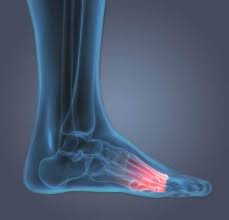 Image result for Foot Pain
