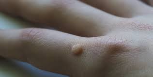 You're more likely to spread a wart or verruca if your skin is wet or damaged. Ask A Dermatologist Warts 101 Columbia Skin Clinic