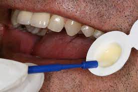 Fluoride Varnish Vs Foam What Research Shows Today S Rdh
