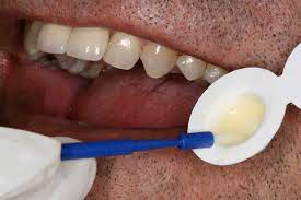 If you're at high risk for. Fluoride Varnish Vs Foam What Research Shows Today S Rdh