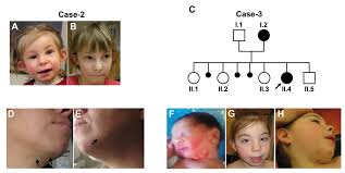 Our case reinforces the notion that amniocentesis offers a more reliable diagnosis of chromosome aberrations. Genes Free Full Text Linear Skin Defects With Multiple Congenital Anomalies Lsdmca An Unconventional Mitochondrial Disorder Html