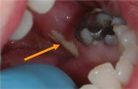 Image result for Bisphosphonates