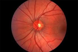 Image result for Optic Neuritis