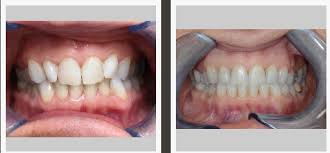 When done the right way, teeth whitening is not bad for your health. Invisalign Invisible Braces Free Teeth Whitening Included