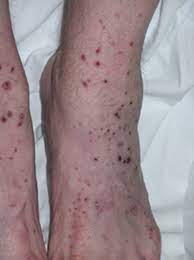 Allergic purpura, also called anaphylactoid purpura, shows up as a skin rash that appears suddenly, most commonly on the arms, legs, buttock, and feet. Microscopic Polyangiitis Johns Hopkins Vasculitis Center