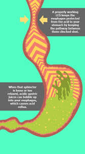 Some people get heartburn when they bend over or lie down. Your Burning Chest How To Stop Acid Reflux And Gerd Unc Health Talk